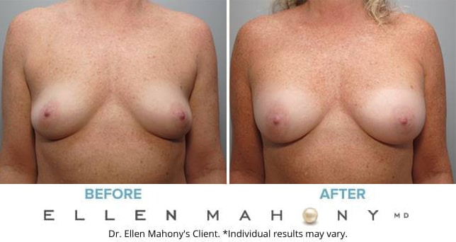 Before and After Image: Case #8750 - front