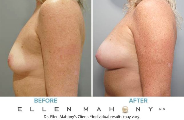 Before and After Image: Case #8750 - left-side