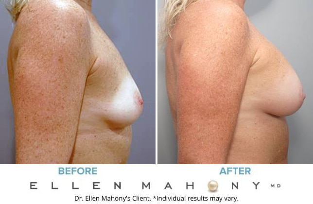 Before and After Image: Case #8750 - right-side