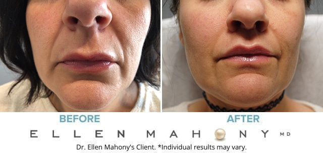 Before and After Image: Case #8763 - front