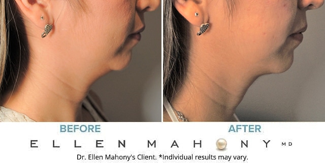 Before and After Image: Case #8796 - right-side