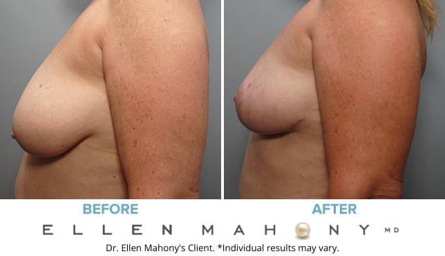 Before and After Image: Case #8831 - left-side