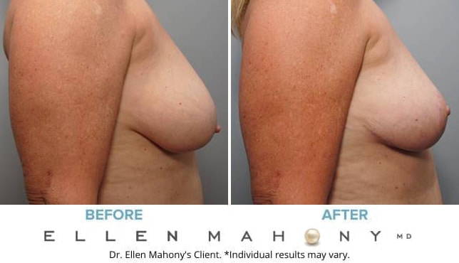Before and After Image: Case #8831 - right-side
