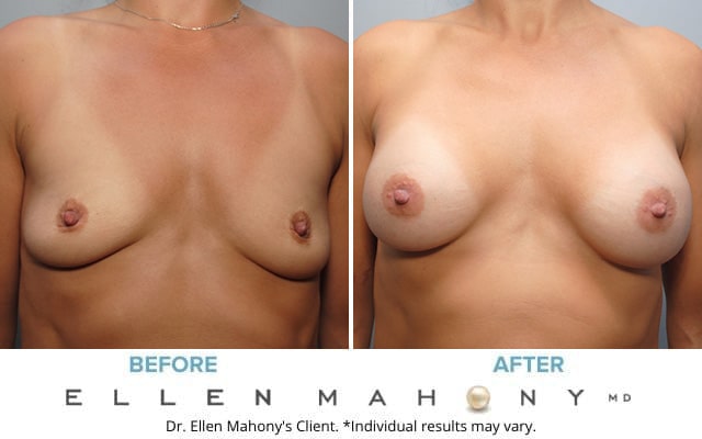 Before and After Image: Case #8909 - front