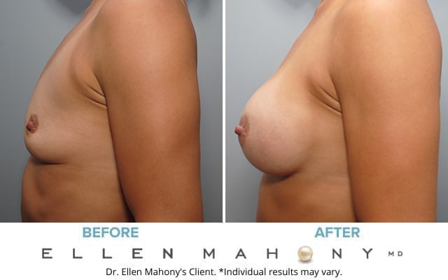 Before and After Image: Case #8909 - left-side