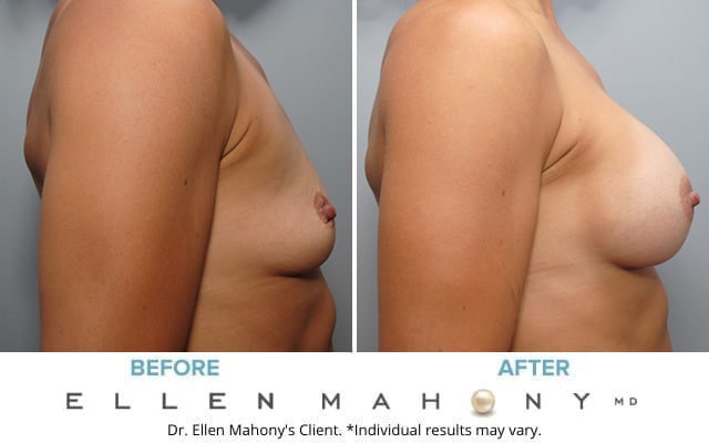 Before and After Image: Case #8909 - right-side