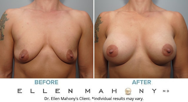 Before and After Image: Case #8927 - front