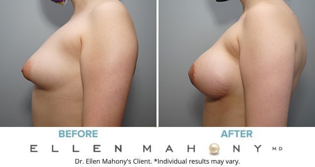 Before and After Image: Case #8982 - left-side