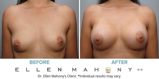 Before and After Image: Case #8993 - front