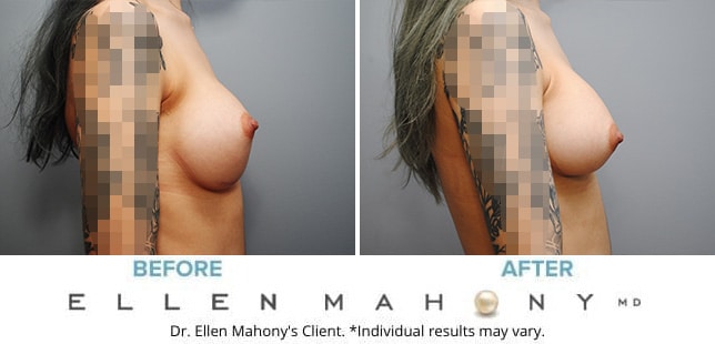 Before and After Image: Case #9002 - right-side