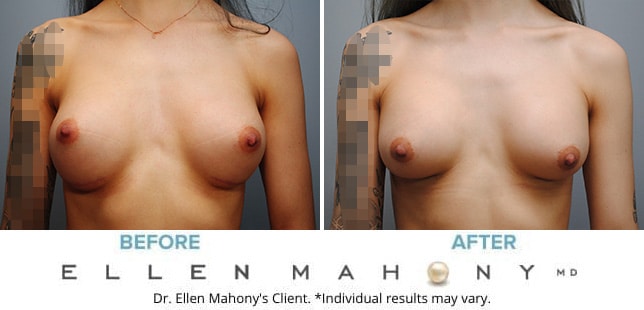 Before and After Image: Case #9002 - front