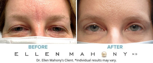 Before and After Image: Case #9071 - front