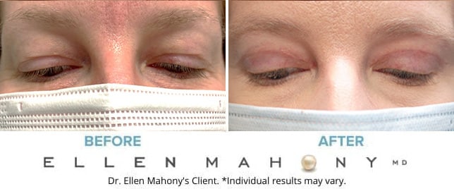 Before and After Image: Case #9071 - front