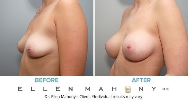 Before and After Image: Case #9097 - left-front-oblique