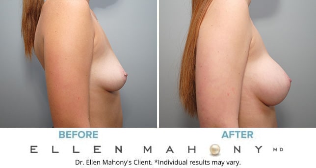 Before and After Image: Case #9097 - right-side