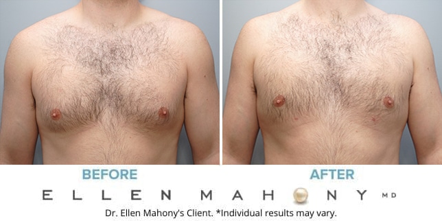 Before and After Image: Case #9150 - front