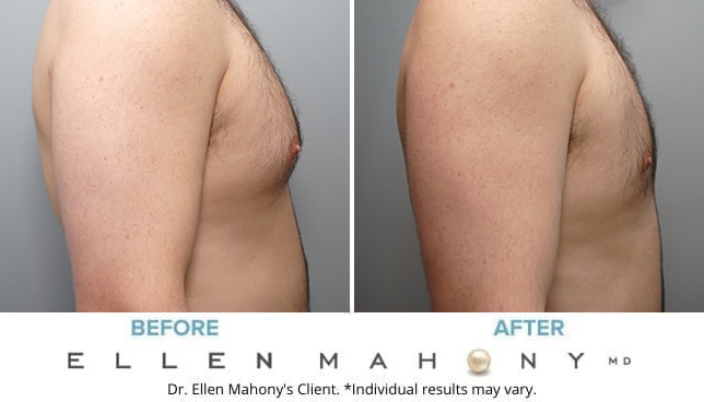 Before and After Image: Case #9150 - right-side