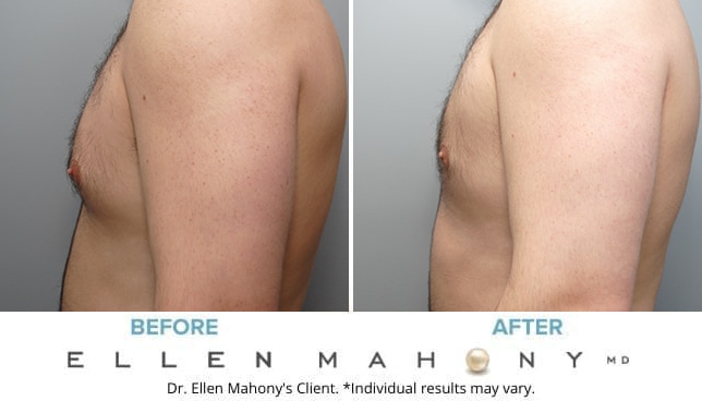 Before and After Image: Case #9150 - left-side