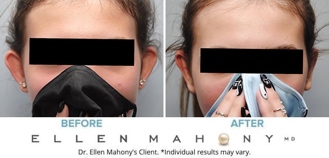 Before and After Image: Case #9180 - front