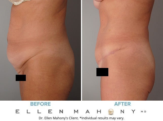 Before and After Image: Case #9182 - left-side