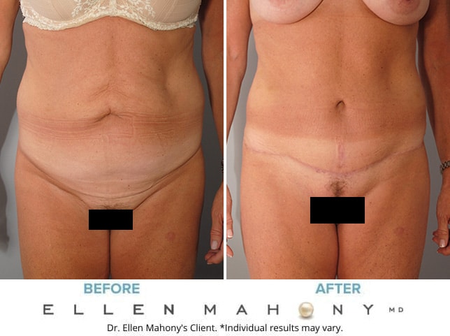 Before and After Image: Case #9182 - front