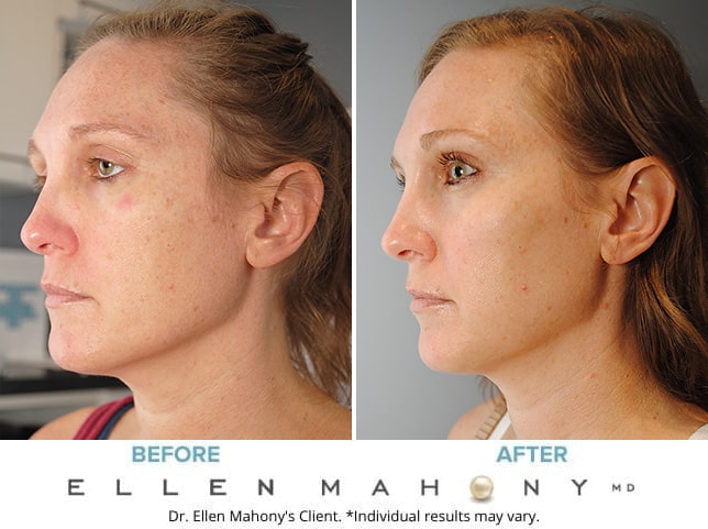 Before and After Image: Case #9278 - left-front-oblique