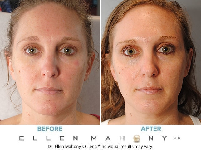 Before and After Image: Case #9278 - front