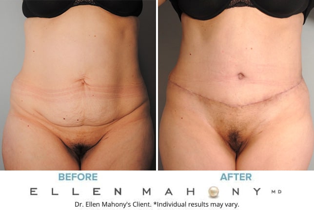 Before and After Image: Case #9356 - front