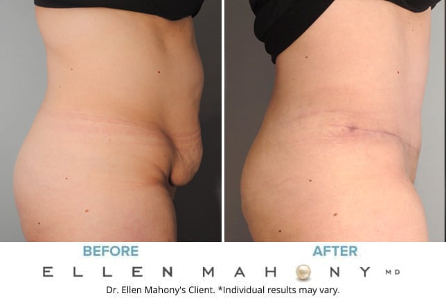 Before and After Image: Case #9356 - right-side