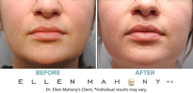 Before and After Image: Case #9485 - front