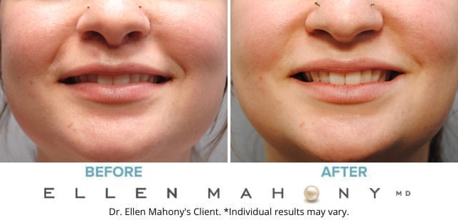 Before and After Image: Case #9485 - front