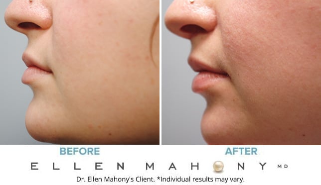 Before and After Image: Case #9485 - left-side