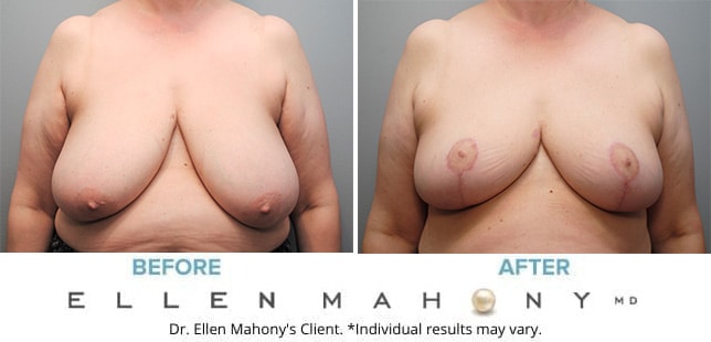 Before and After Image: Case #9569 - front