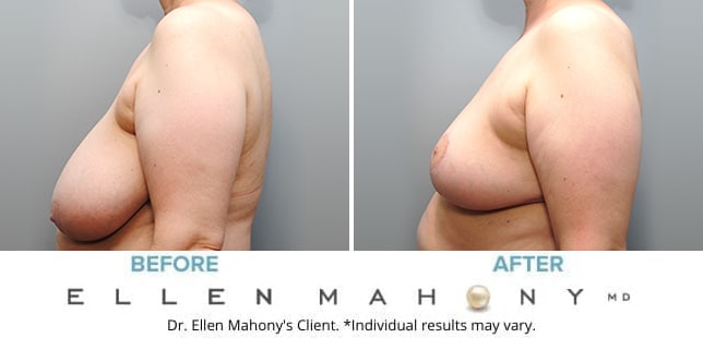 Before and After Image: Case #9569 - left-side