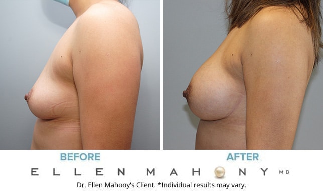 Before and After Image: Case #9930 - left-side