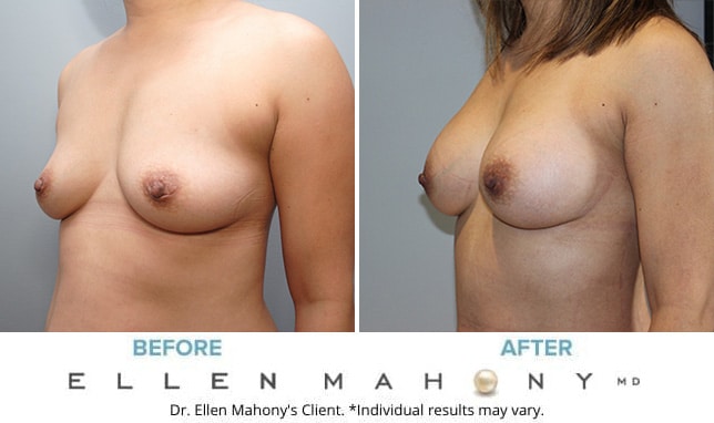 Before and After Image: Case #9930 - left-front-oblique