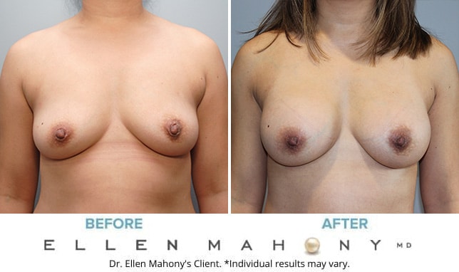 Before and After Image: Case #9930 - front
