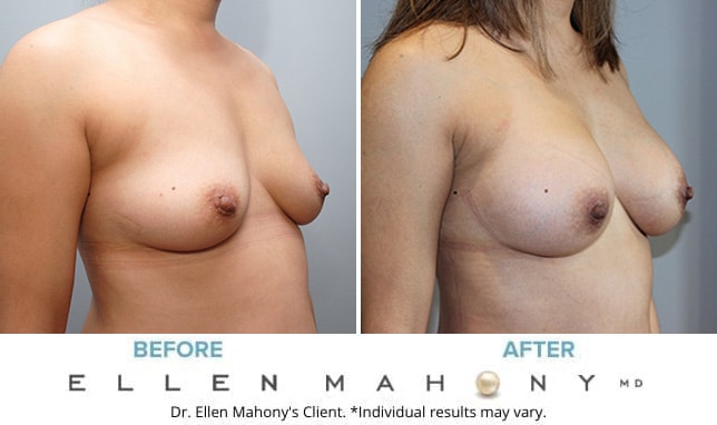 Before and After Image: Case #9930 - right-front-oblique