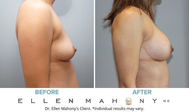 Before and After Image: Case #9930 - right-side