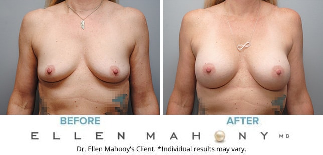 Before and After Image: Case #9987 - front