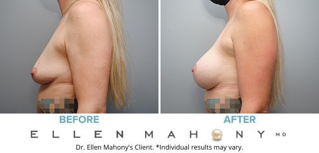 Before and After Image: Case #9987 - left-side