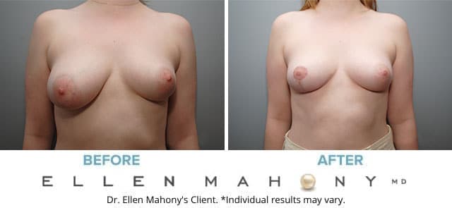 Before and After Image: Case #8124 - front
