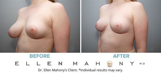 Before and After Image: Case #8124 - left-front-oblique