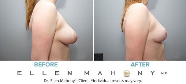 Before and After Image: Case #8124 - right-side