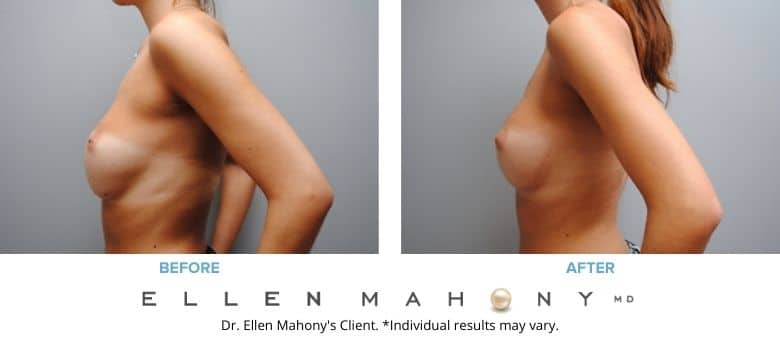 Before and After Image: Case #2765 - left-side