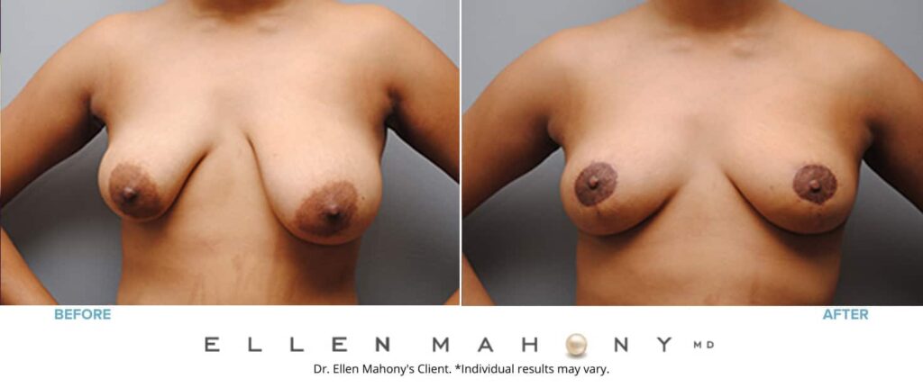 Before and After Image: Case #4927 - front