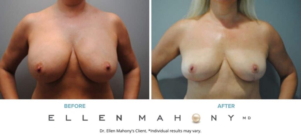 Before and After Image: Case #6184 - front