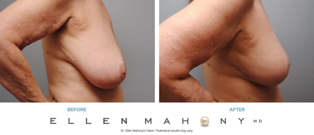 Before and After Image: Case #6216 - right-side