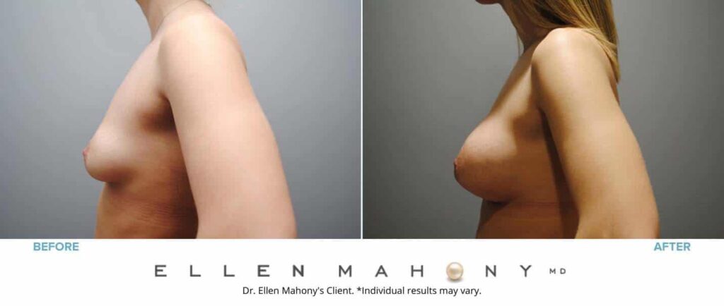 Before and After Image: Case #6352 - left-side