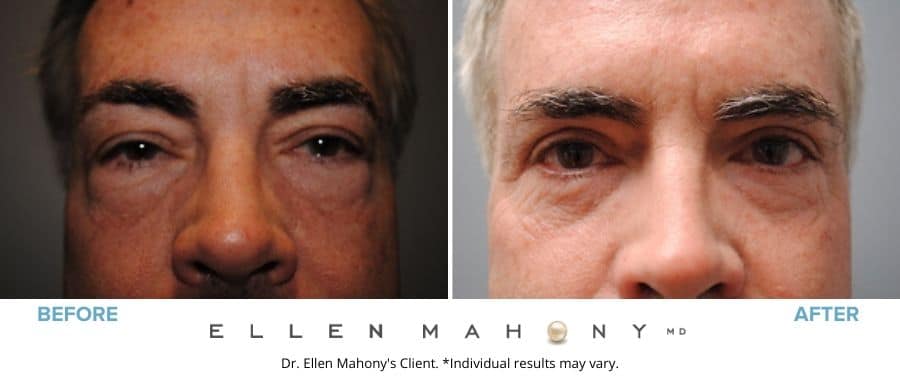 Before and After Image: Case #3273 - front